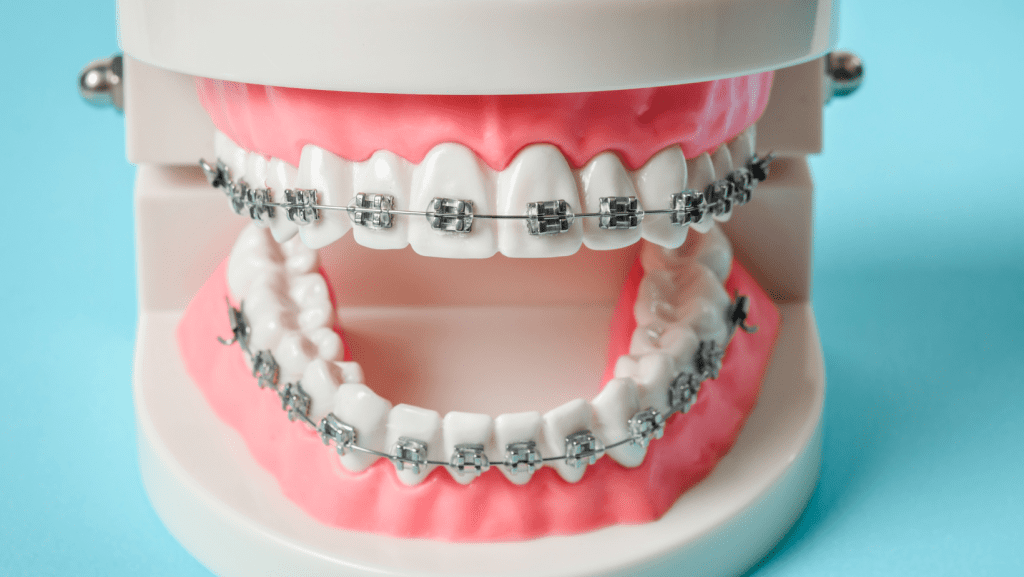 Unlock Your Smile Top 7 SA Medical Aids Now Covering Braces in 2023